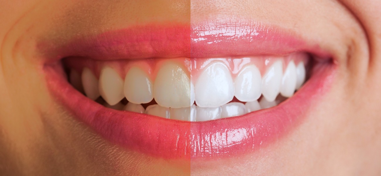 Illustrative comparison of tooth shades