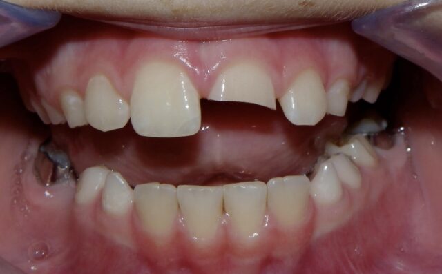 Crafting Your Perfect Smile with Veneers