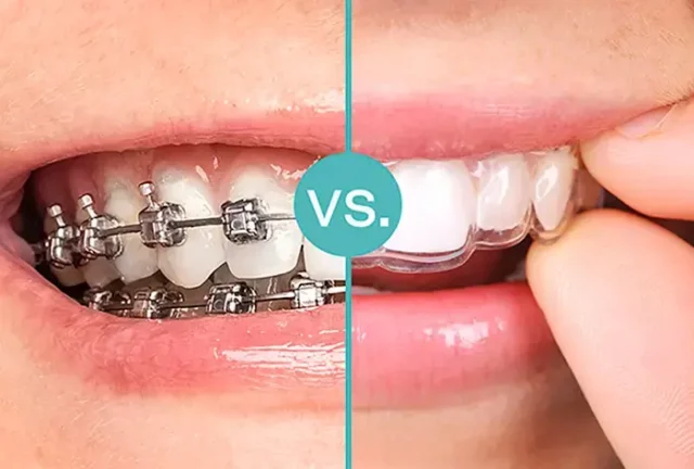 Aligners and Braces Image