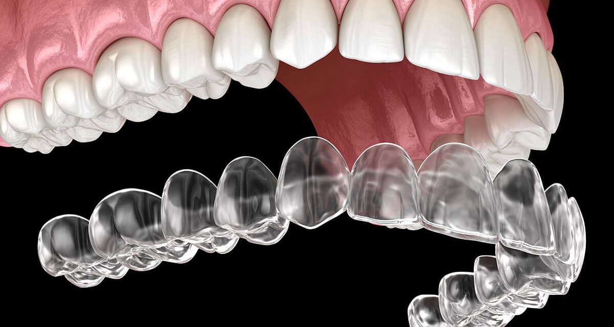 Embracing the Magic of Aligners for Your Perfect Smile!