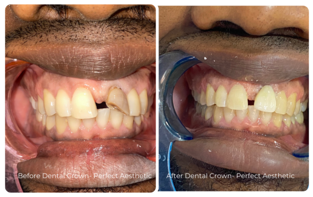 Dental Crown - Perfect Aesthetic Clinic