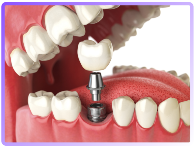 Dental implant - Perfect Aesthetic