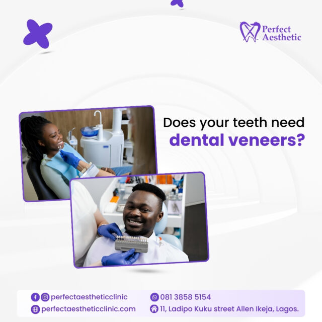 5 Reasons You Might Need Dental Veneers