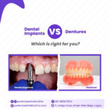 Dental implants vs Dentures