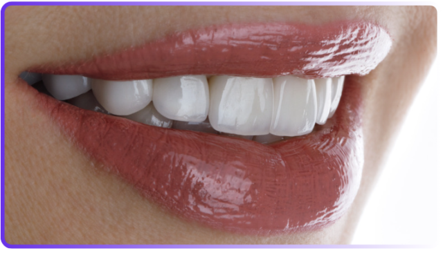 Dental Veneers